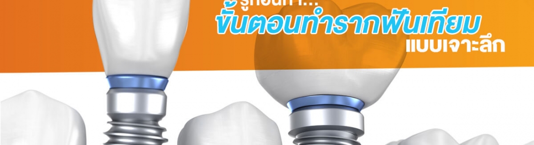รู้ก่อนทำ ขั้นตอนทำ รากฟันเทียม แบบเจาะลึก